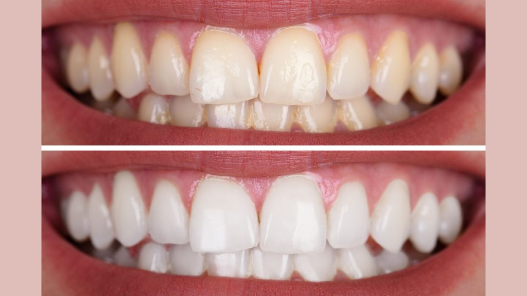 Brighten Your Smile: The Ultimate Guide to Teeth Whitening Techniques