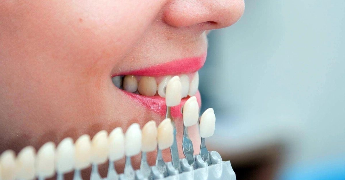 Achieving the Hollywood Smile: Your Guide to Dental Veneers