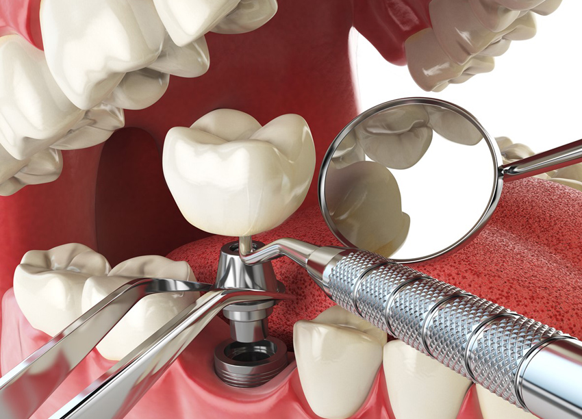 Everything You Need to Know About Dental Implants: Costs, Benefits, and Care