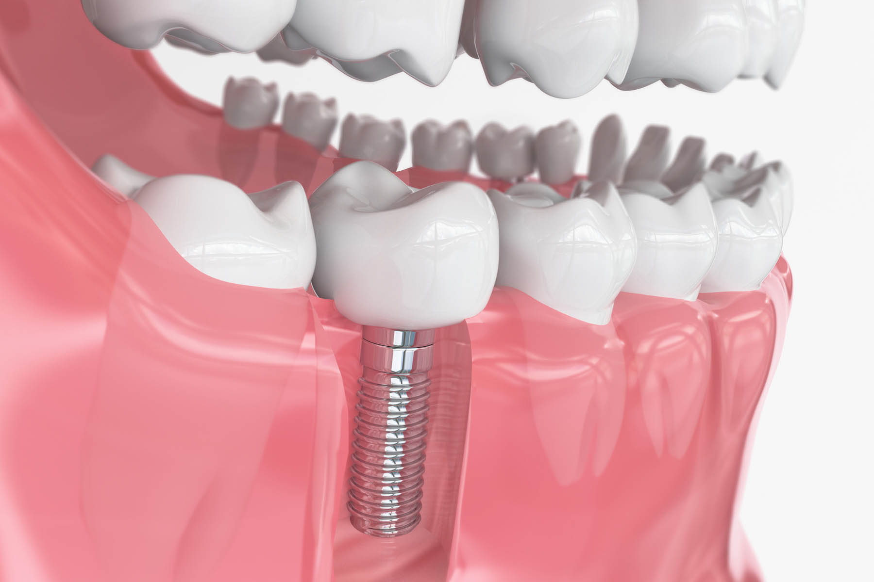 Why Dental Implants Are the Best Solution for Missing Teeth