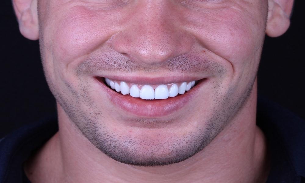 The Pros and Cons of Dental Veneers: Are They Worth It?