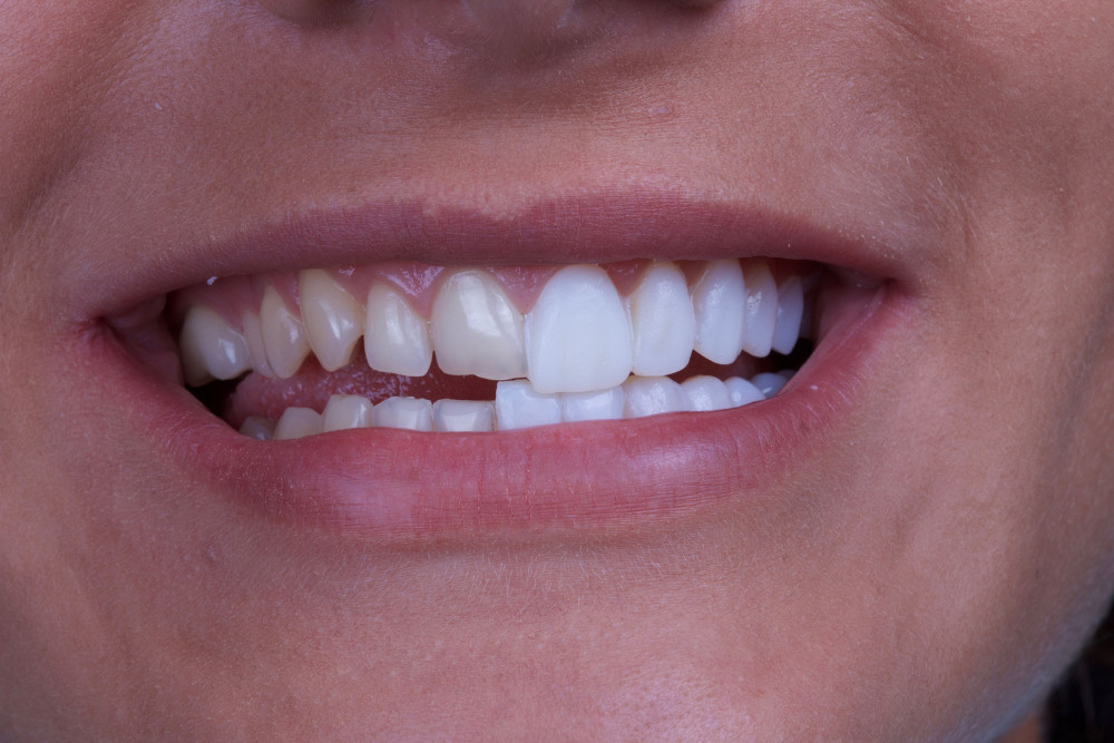 How Dental Veneers Can Enhance Your Smile and Confidence