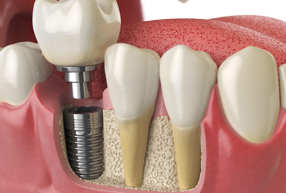 The Ultimate Guide to Dental Implants: What You Need to Know