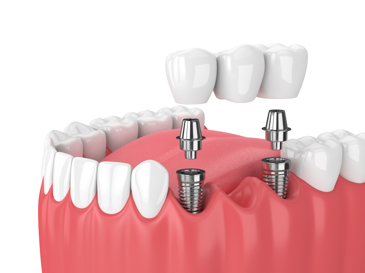 How Dental Implants Can Transform Your Oral Health